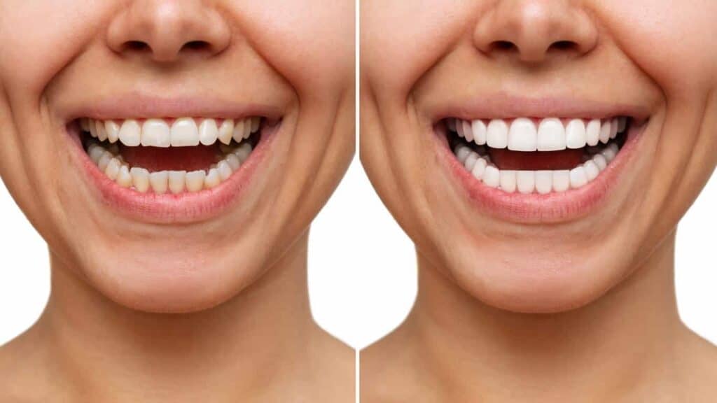 Contact Aspire White for teeth whitening services – Get in touch with Rotherham today