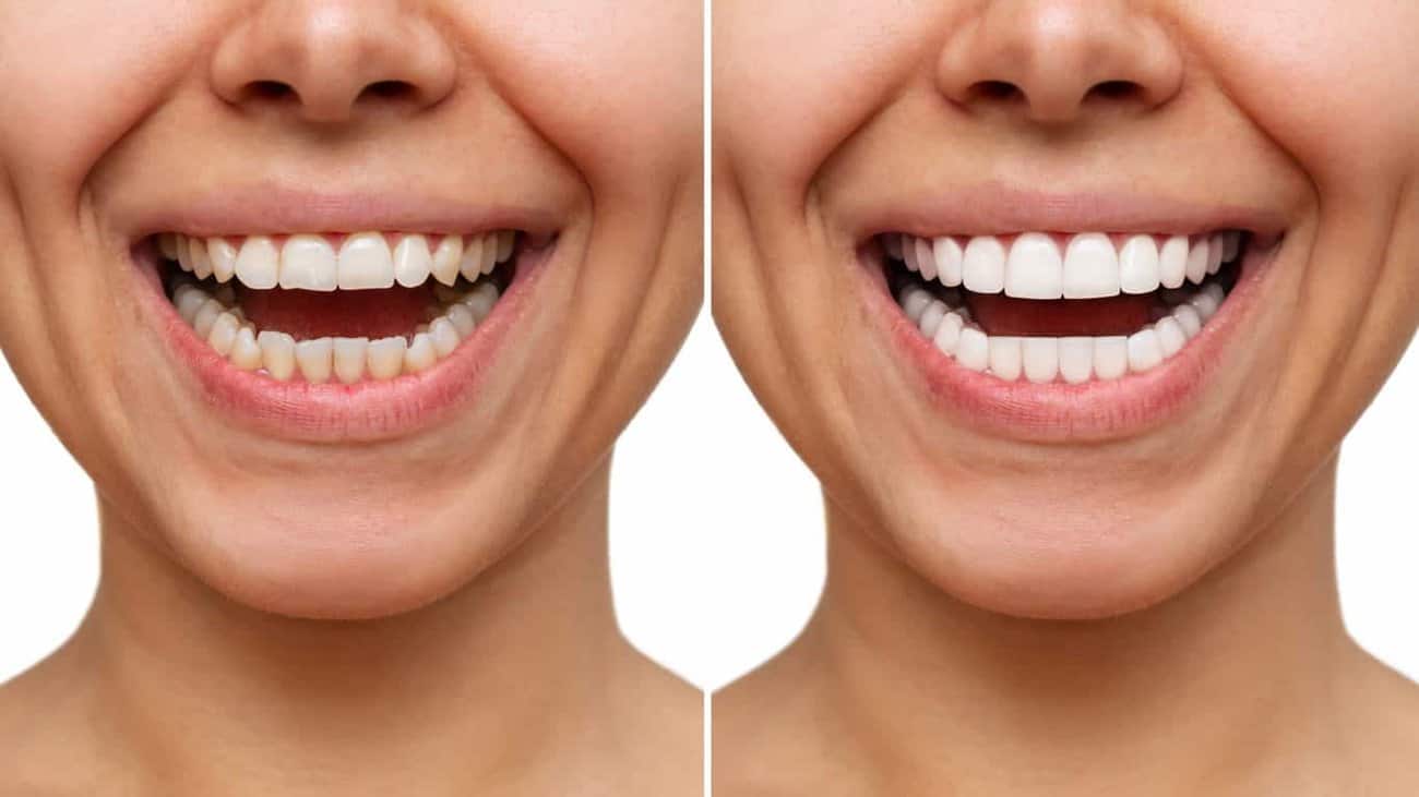 Contact Aspire White for teeth whitening services – Get in touch with Rotherham today