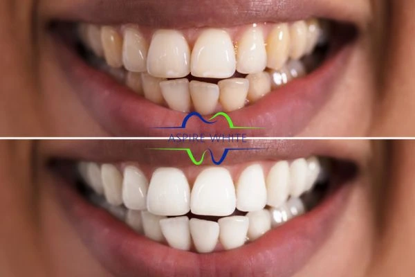 Aspire White customer before and after Rotherham results.