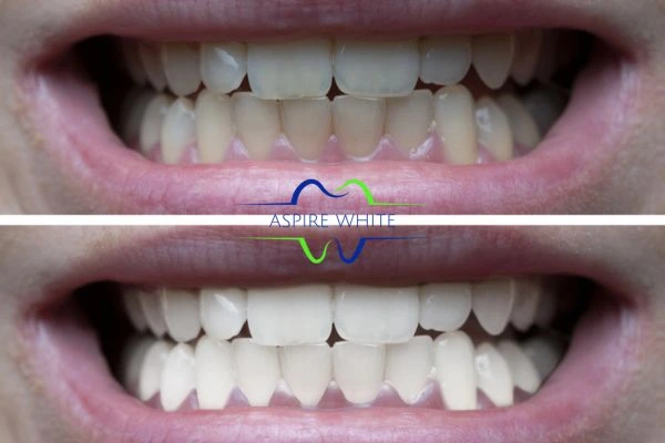 1 hour laser teeth whitening before and after results Rotherham