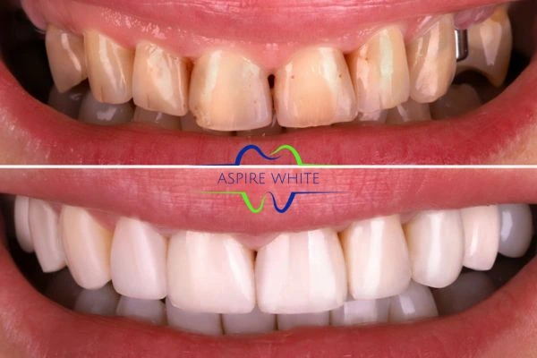 Before And After Results Rotherham