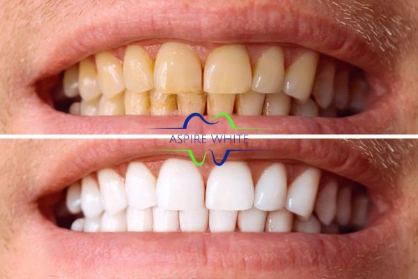 Get noticeable whiter smile in just one hour! Book your teeth whitening treatment Rotherham today!