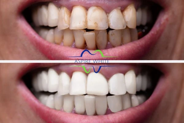 Before and after results of laser teeth whitening Rotherham Book in online today!