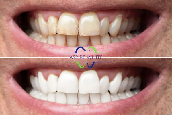 Achieve a radiant smile with professional laser teeth whitening Rotherham